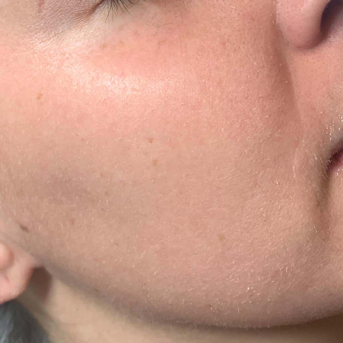 chemical peels peel after after tx fine line aesthetics