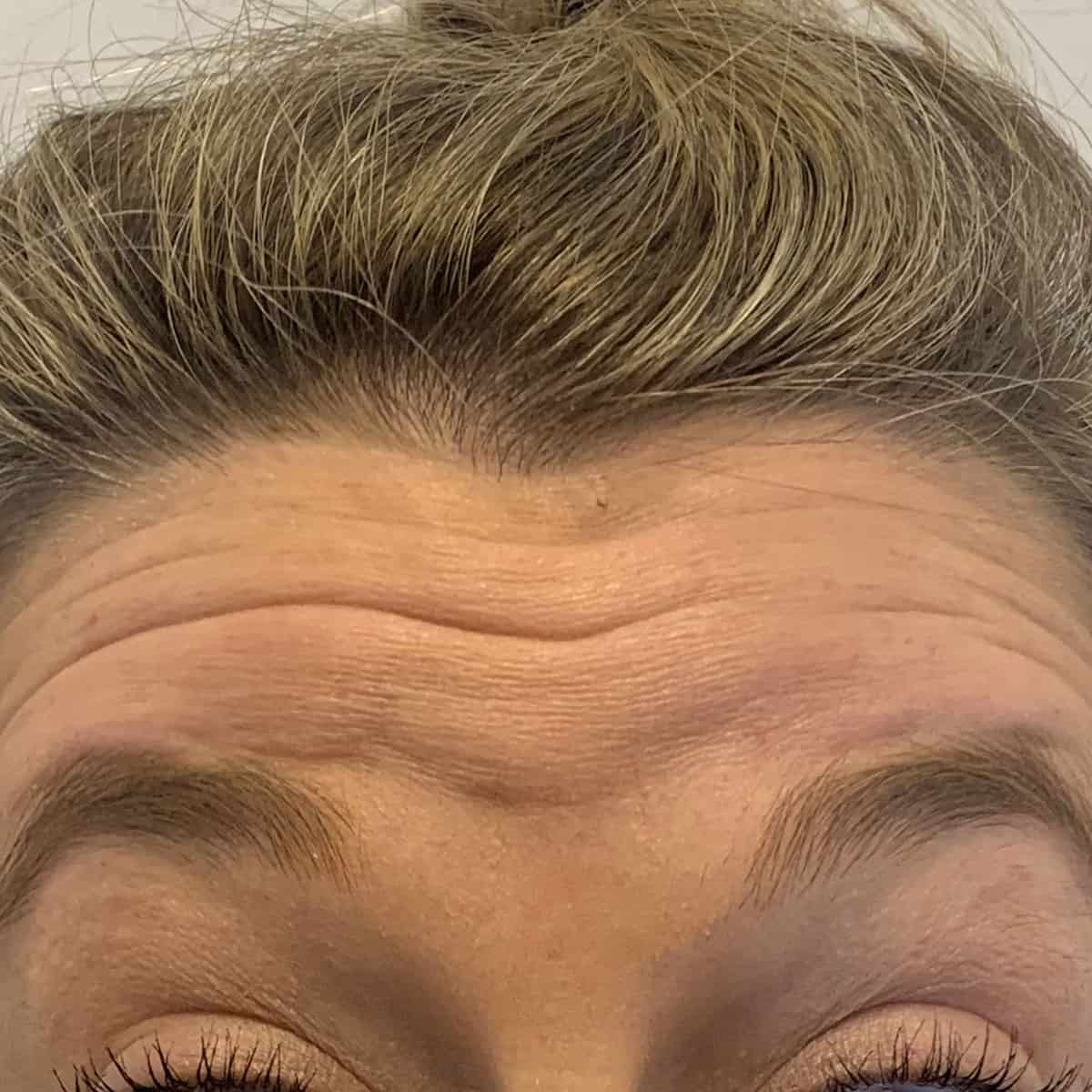 Before Botox into Forehead Lines